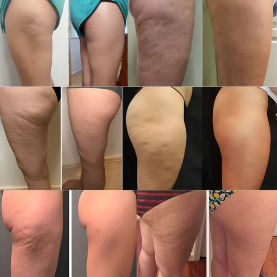 Aceite Anticelulitis™ | Resultados en 48h